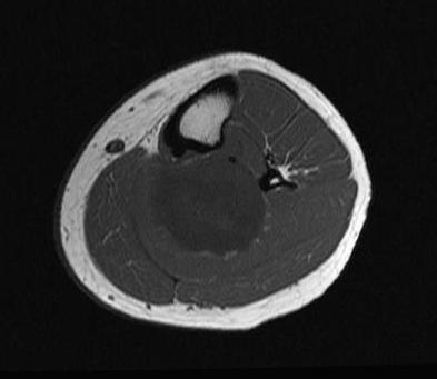 Neurofibrosarcoma NF Leg MRI Axial T1